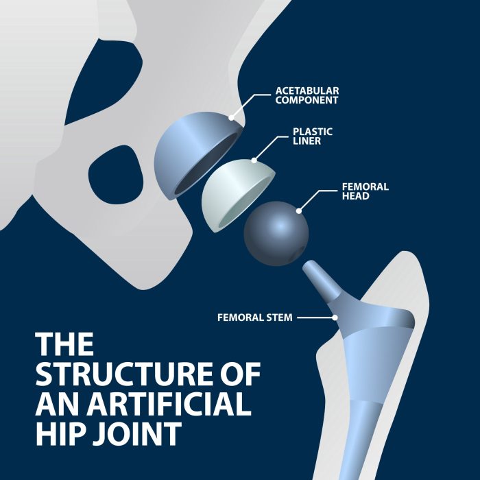 Simulation real life 4.0 total hip arthroplasty