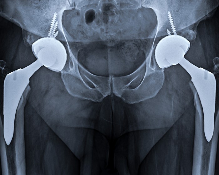 Hip arthroplasty total zimmer successful epidermolysis bullosa case figure cannulated prosthesis screws fixated cementless via using cureus